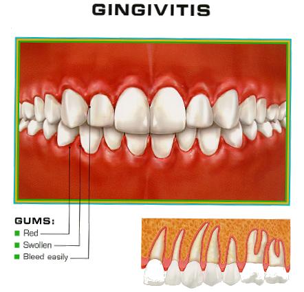 Zeolit zeodent gingivitis